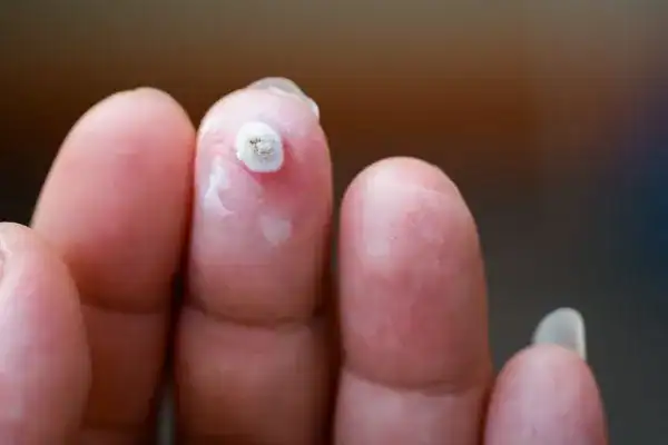 Image of white wart before cryopen treatment Altrincham