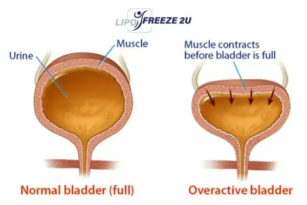 diagram of overactive bladder treatment Altrincham