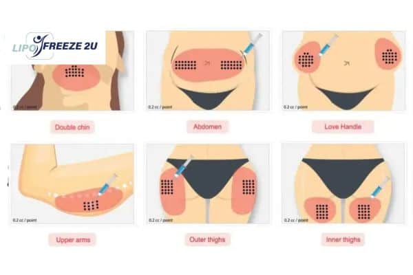 Benefits of Choosing Aqualyx for Fat Reduction Altrincham