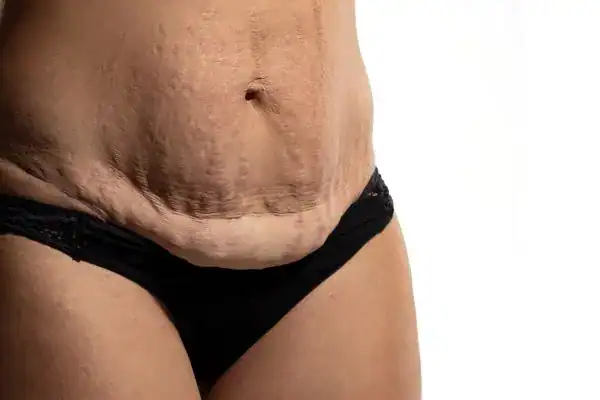 loose skin after weight loss injections Altrincham