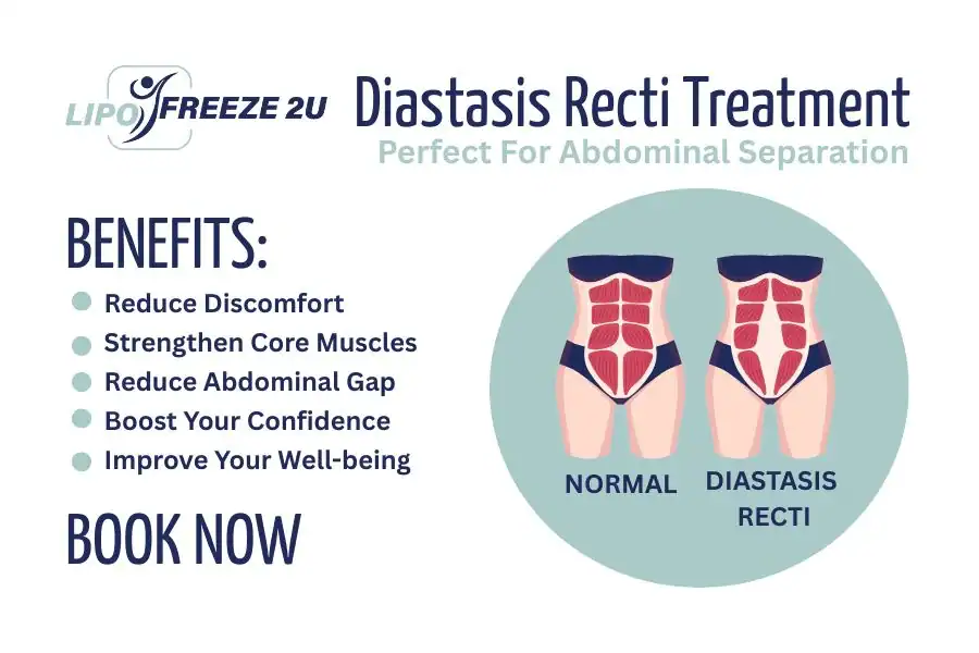 How Long Will It Take to See Improvements in Diastasis Recti Altrincham
