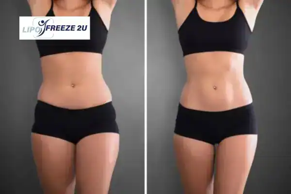 How Can LIPO FREEZE 2U Support Your Post-Pregnancy Body Recovery Altrincham?