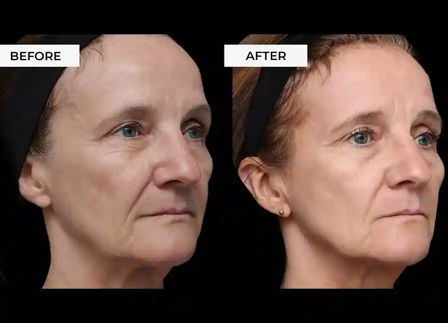 How Many RF Microneedling Sessions Will You Need to See a Difference Altrincham?
